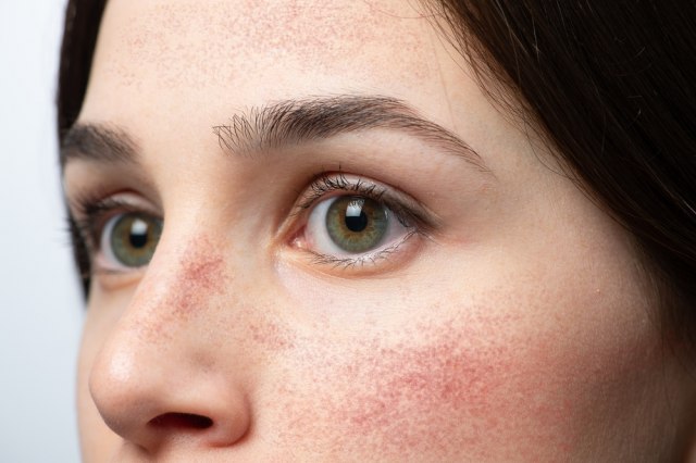 Crvenilo i vidljive vene na koži su simptomi: Njegova pojava ukazuje na disbalans u organizmu